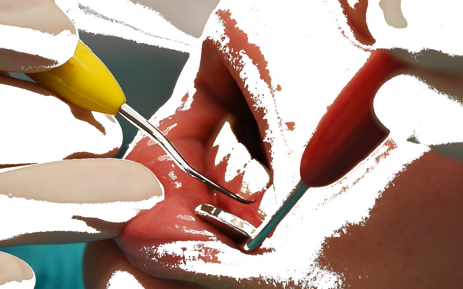 Dental curette (Gracey-style)